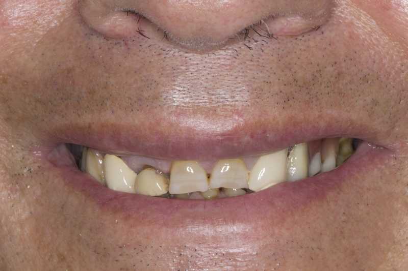 Fractura e desgaste de toda a dentição devido a Bruxismo. Reabilitado com Coroas Dentárias e Coroas Sobre Implantes.