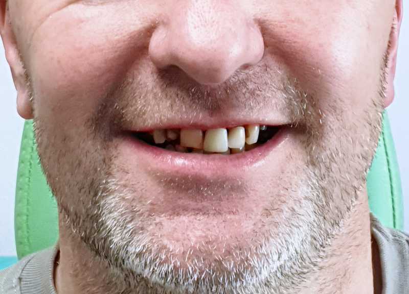 Asymmetries in the dentition and smile, carious lesions, darkened and stained teeth. The patient underwent dental whitening and was treated with dental implants and ceramic crowns.